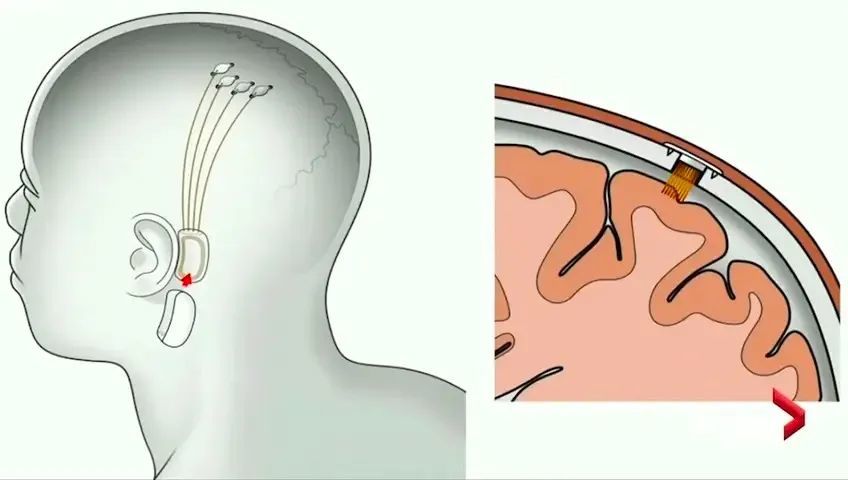 马斯克的脑机接口，如何又一次引发科学家的不满？